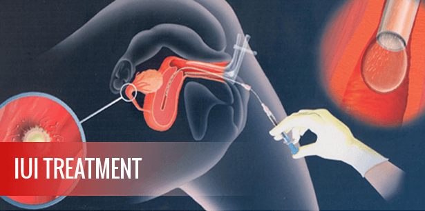 IUI Treatment Center Delhi, Intrauterine Insemination