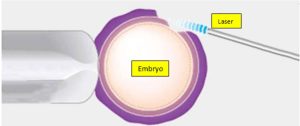 Laser Assisted Hatching processing inside Akanksha IVF Laboratory